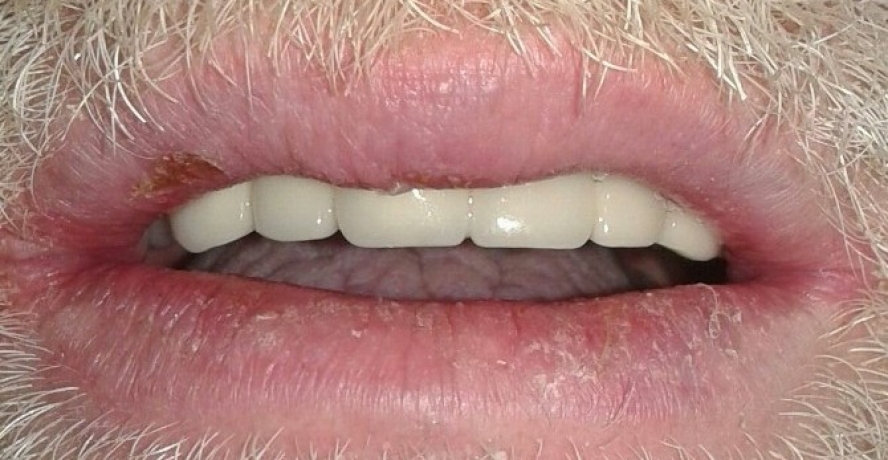 Dişleri Tamamen Çürüyen Hastaya Yeni Dişler Yapıldı