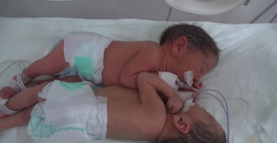 Siyam İkizleri Başarılı Ameliyatla Ayrıldı